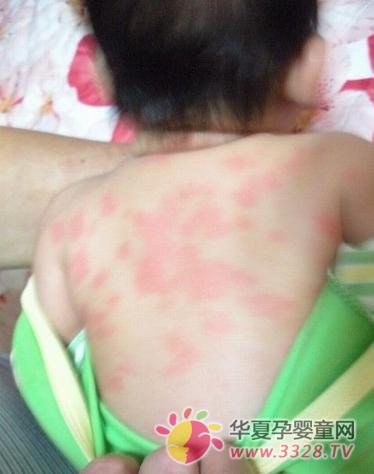 荨麻疹