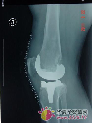 腿部畸形