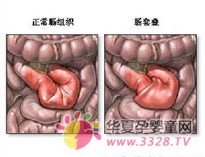 肠套叠