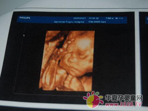 彩超图如何看生男生女